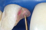 Figure 3  Initial caries removal. Application of caries-indicator solution did not stain the dentin. Extremely soft dentin often does not allow penetration of the dye, creating a false negative caries assessment (original magnification, 8x).