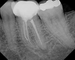 The patient presented with a separated file in the middle of the MB root, short fills on the mesial and distal roots, and a missed distal canal. Periapical lesions were present at the apex of the mesial and distal roots.