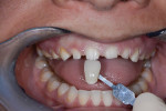 A stump-shade photograph should be taken with each case to help the lab technician determine the type and amount of opaque
porcelain needed to mask the internal color. As seen here, the dentin shade for this patient was quite light.