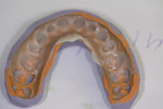 The temporary crowns and veneers were created from a putty matrix created from wax-ups. The author prefers putty stents as opposed to plastic matrices.