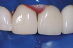 Figure 8  Immediate postoperative view. The long, infinity-edge margin allowed an ideal esthetic result.