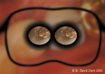 Figure 10  8x convergent magnification with loupes and a representation of the two images that the brain receives as the eyes begin to focus.
