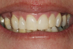 Figure 2  Posttreatment view of teeth Nos. 9 and 10 esthetically restored with direct resin veneers (Premise).