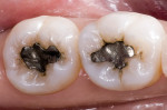 Figure 4 Preoperative occlusal view of defective amalgam restorations with recurrent decay.