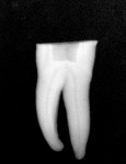 Radiograph of extracted tooth to demonstrate preoperative canals.
