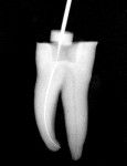 Radiograph confirming glide-path creation using SafeSider instruments.
￼￼￼