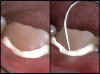 Fig 1. Monolithic zirconium abutment replacing the maxillary left central incisor.