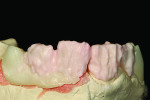 Fig 13a. A-1 base dentin is applied.