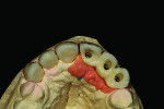 Fig 14. Facial contour check for teeth Nos. 6 through 11.