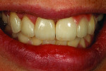 Fig 23. Immediate smile view with tooth No. 8 added.