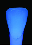 Fig 5. The fluorescent characteristics of a natural tooth.