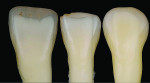 Fig 8. Natural anterior teeth demineralized.