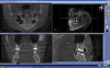 Fig 5. Preoperative photographs showing implant in place of maxillary left central incisor.