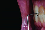 Fig 11. A single central incisor is presented for restoration.