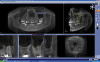 Fig 6. Preoperative photographs showing implant in place of maxillary left central incisor.