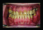 Fig 24. A Class III patient who declined surgical procedures to rehabilitate his smile.