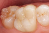 Fig 11. Margins were placed on abutment to correspond to slightly supragingival margins to facilitate easy final cement removal. All lithium disilicate below gingival height was stained to match natural tissue shading, thus reducing shine-through of implant abutment through tissue, which would compromise final esthetic result.