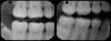Fig 18. The definitive restorations on the master model.