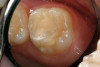 Fig 22. The margins of the restorations were then “waved” for 2 to 3 seconds per tooth facially and lingually.