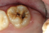 Fig 24. Final restorations 7 months after cementation of the crowns.