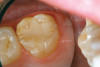 Fig 25. Final restorations 7 months after cementation of the crowns.