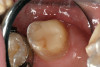 Fig 26. Final restorations 7 months after cementation of the crowns.