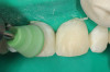 Full-coverage lithium disilicate crowns luted with a self-curing resin-based dental luting material with a light-curing option (Multilink® Automix, Ivoclar Vivadent, www.ivoclarvivadent.com). Ceramics by Gold Dust Dental Lab.