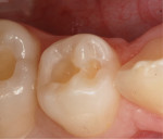 Fig 9. Caries-free tooth ready for restoration.