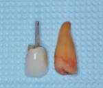Fig 2. Extraction of the root of No. 6 adjacent to the PFM crown containing the prepared tooth structure and post.