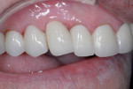 Fig 18. The final all-ceramic crown cemented onto a zirconia CAD/CAM custom abutment.