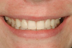 Figure 14  View of the patient"s final smile makeoverdemonstrating the youthful appearance thatwas achieved with minimally invasive dentistry.