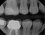 Figure 7. Partial-coverage seated radiograph.