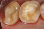 Occlusal view of tooth preparation on teeth Nos. 14 and 15.