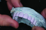Figure 6. Crowns are seated on solid model with proper contacts and interproximal embrasures.