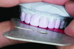 Figure 7. Using the occlusal plane analyzer to create an even incisal edge pattern.