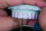 Figure 9. Bevelling the lingual incisal edge with a green rubber wheel.