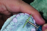 Figure 10. Checking mesial distal line angles against temporaries.