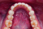 Figure 13. Lower corrected arch is seated in the patient’s mouth.