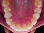 Figure 14. Upper corrected arch is seated in the patient’s mouth.