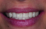 Figure 15. Patient showing a natural smile with final restorations.