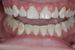 Patient presentation following orthodontic treatment. Note the gingival hypertrophy biofilm plaque white spot lesions.