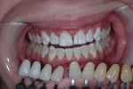 Post-treatment results of in-office whitening show color change from A2 to 020 bleach.