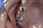 Case 2 presentation showing fractured lingual cusp on tooth No. 13.