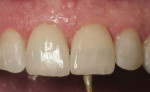 Occlusal adjustment on teeth Nos. 8 and 9 with a fine-grit diamond bur (The Brasseler USA KS4, Brasseler USA Dental, brasselerusa.com) at a slow speed of 50,000 rpm with water spray.