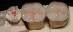 Monolithic, full-contour, lithium-disilicate, full-contour crowns fabricated and polished prior to additional staining and glazing.