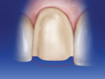 Figure 9  The incisal depth cuts are connected,creating a uniform reduction that follows the originalcurvature of the incisal edge.