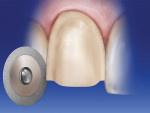 Figure 10   A thin double-sided diamond disk isused to break contact between the prepared teeth.