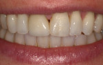 Fig 10. Papillary deficiency between maxillary central incisor teeth and the mesio-distal dimensions were apparent during normal smile.