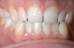 Figure 1  Early enamel loss and some dentinexposure along the cervical margins of the teeth.The cause in this case was identified when thepatient admitted to toothbrushing immediatelyafter drinking pure orange juice.