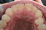 Figure 2  The erosion on the palatal surfacesof the upper incisors was more advanced thanon the bicuspids, which show earlier signs oferosion. The cause could not be attrition, so themost likely explanation was erosion. The typicalhollowed-out occlus
